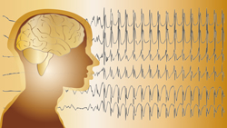 Seizures and Epilepsy